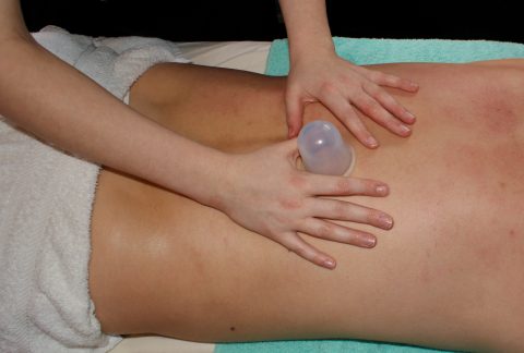 Cupping
